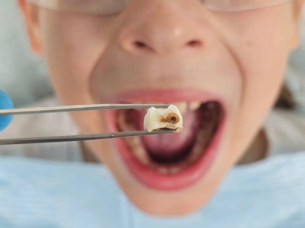 Best Emergency Dental Care for Broken or Chipped Teeth in Crystal City, TX